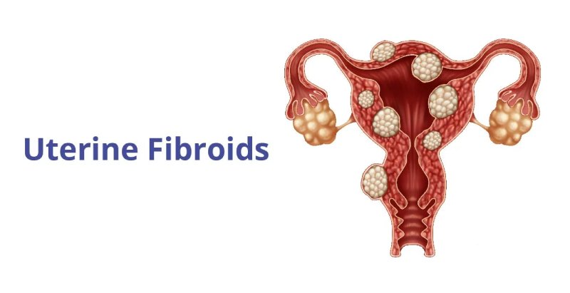 An anatomical illustration of the uterus showing multiple uterine fibroids.